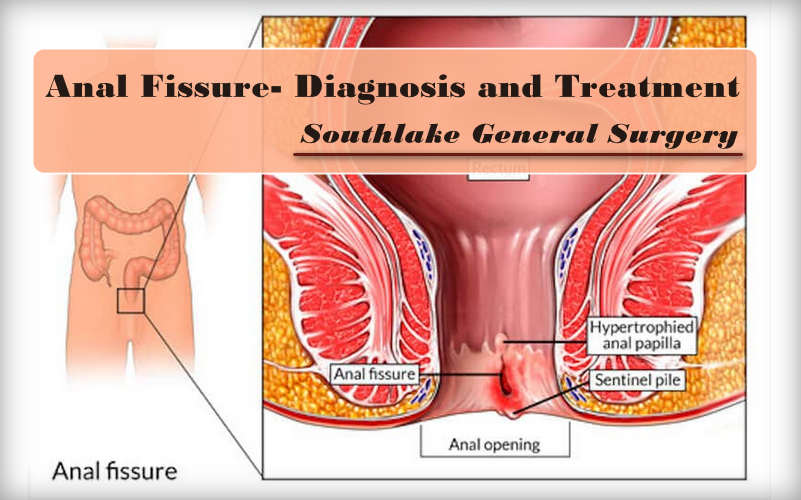 Understanding-and-Diagnosis-Anal-Fissures