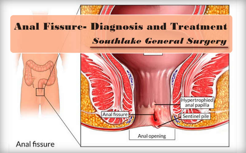 Anal treatment