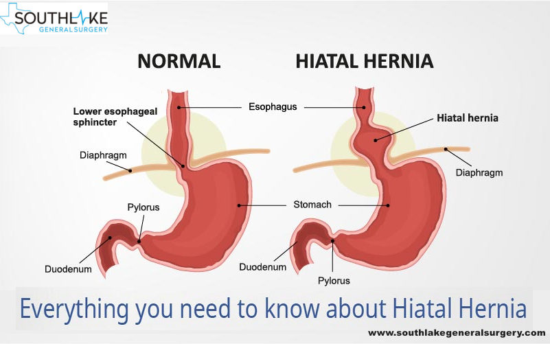 Hiatal Hernia Repair