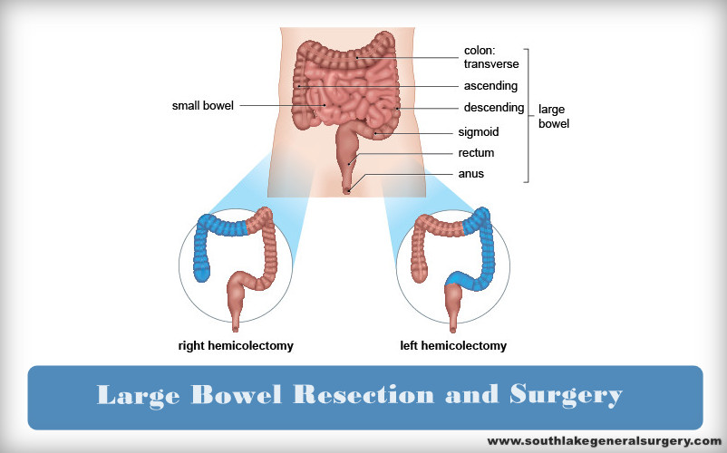 large-bowel-rescetion-southlake-texas