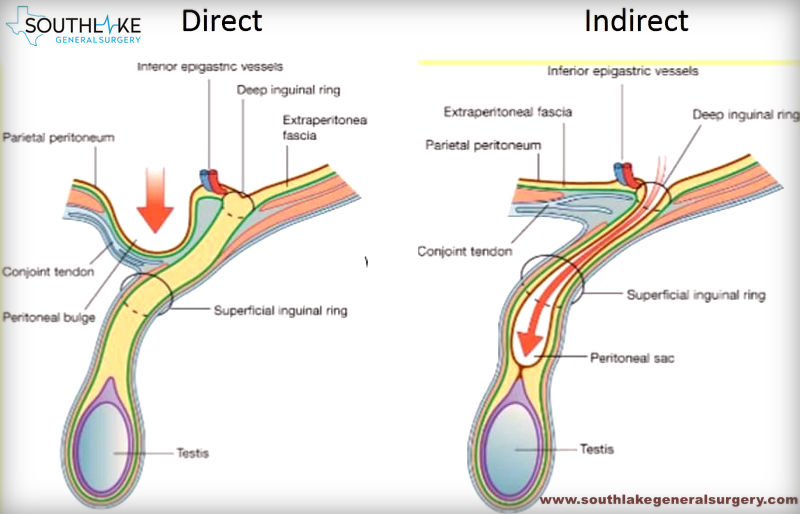 INGUINAL CANAL - Medicine with Yugandhi