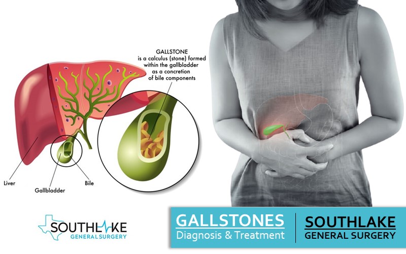 Gallstones Diagnosis and Treatment