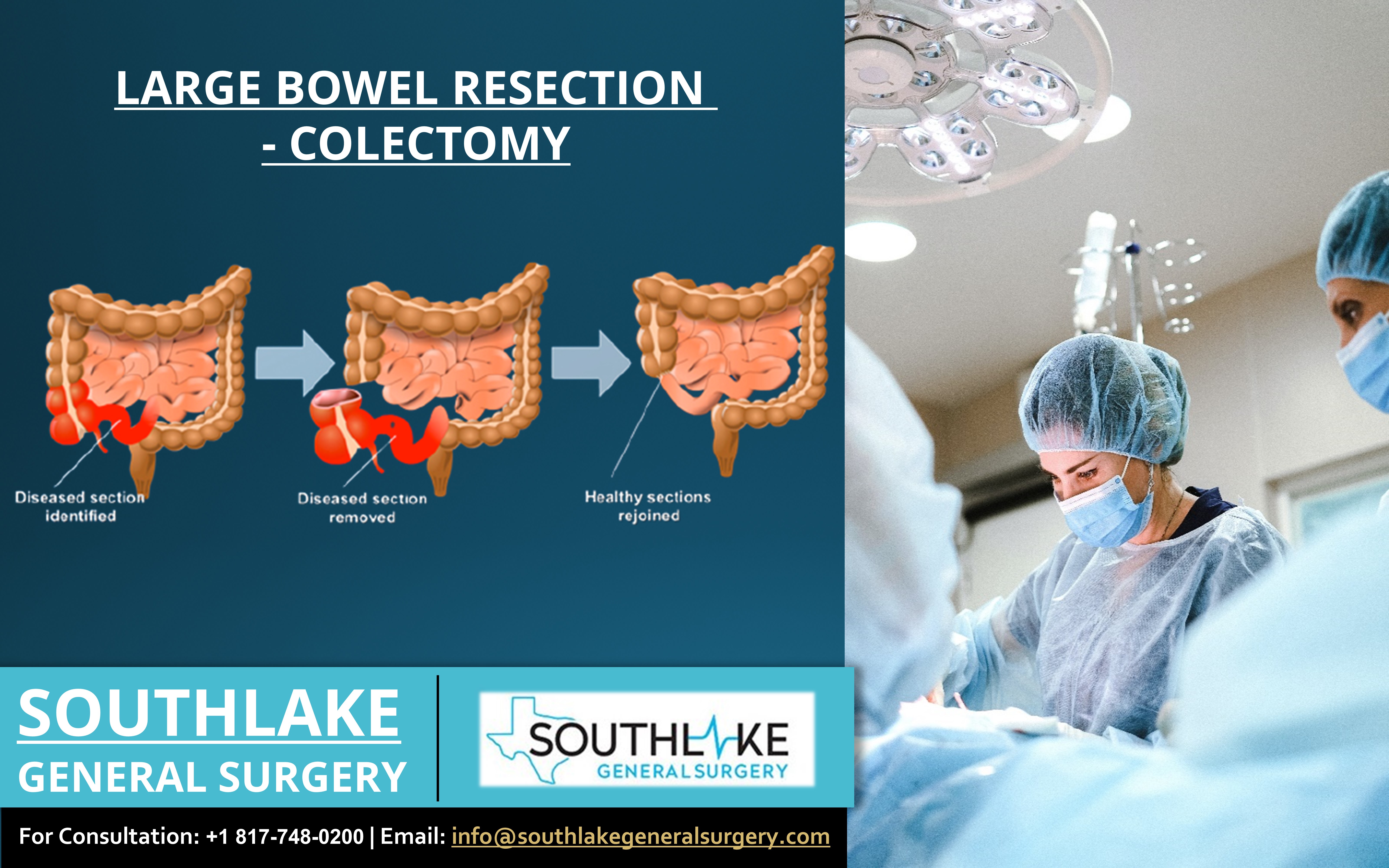 Large Bowel Resection (Colectomy)