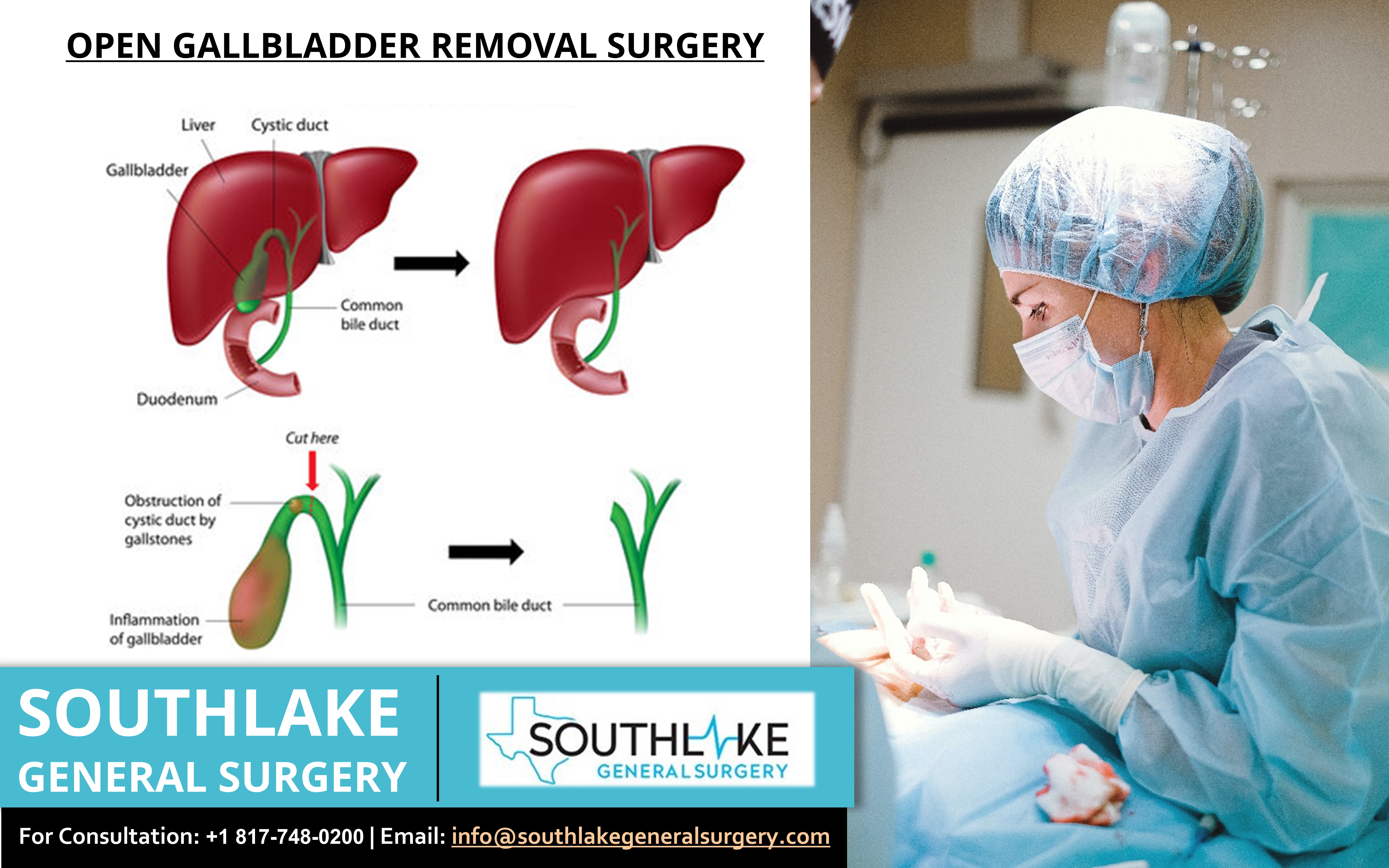 Open Gallbladder Removal Surgery at Southlake General Surgery, Texas