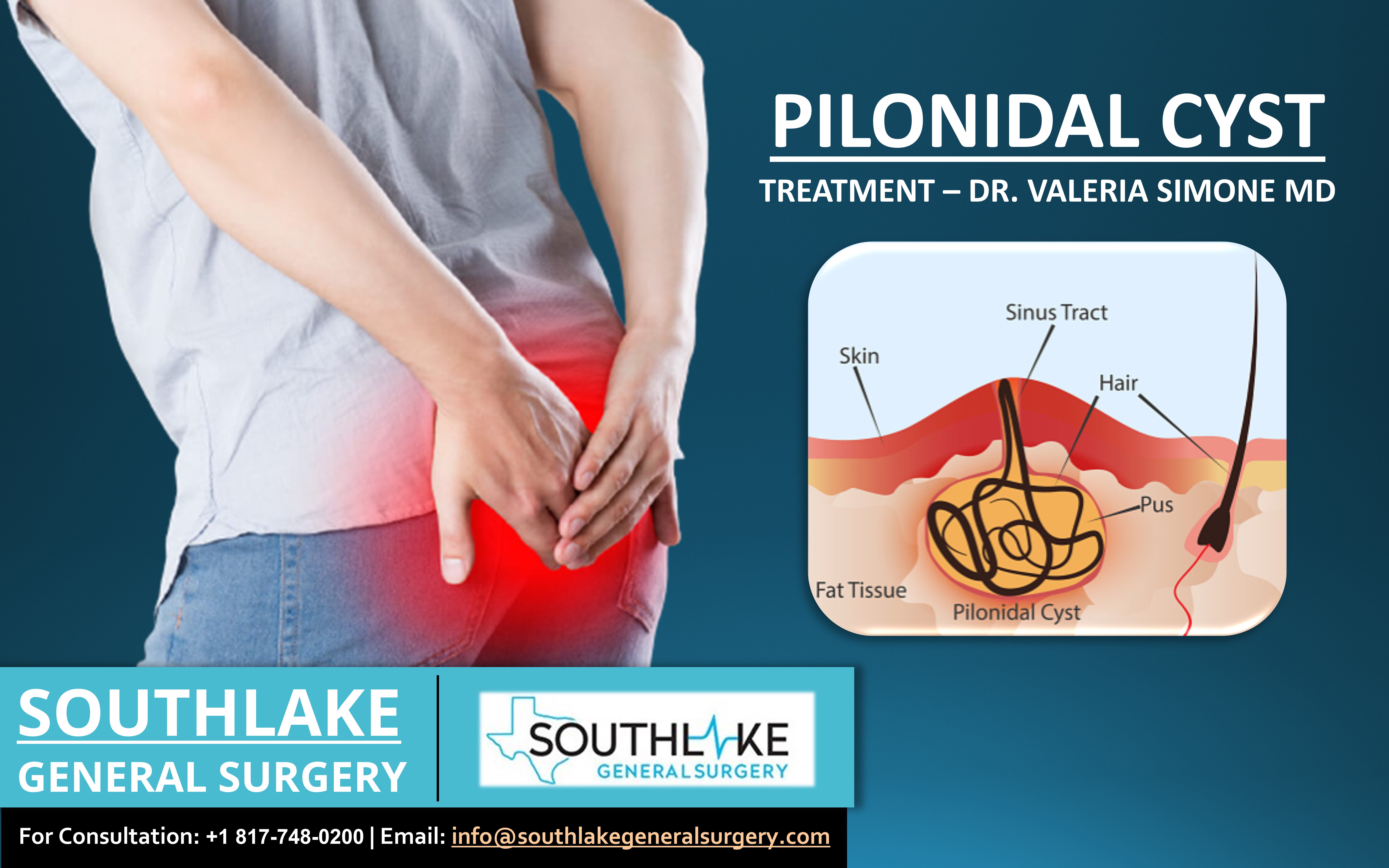 Pilonidal Cyst Treatment Dr Valeria Simone Md Southlake General 