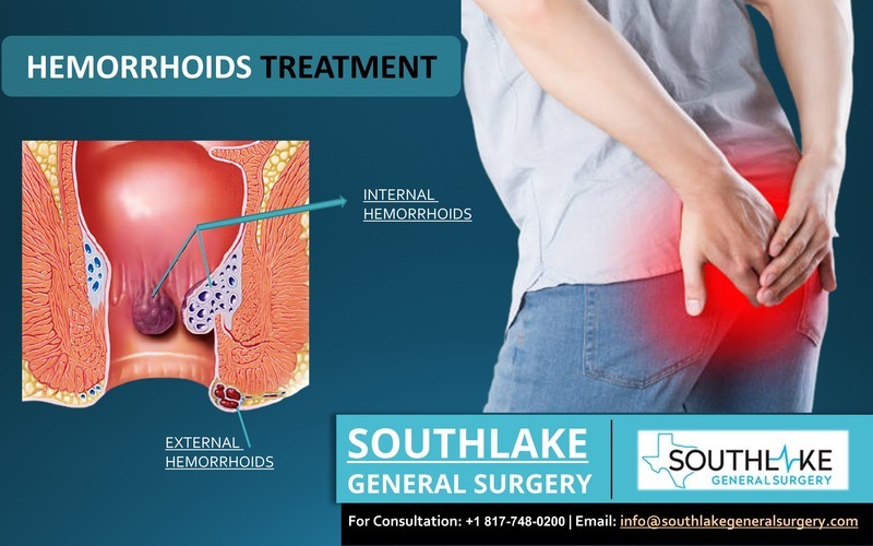 Hemorrhoids Treatment at Southlake General Surgery, Texas