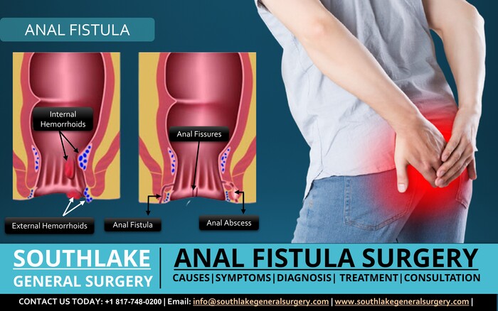 Anal Fistula - Causes, Symptoms, and Surgery