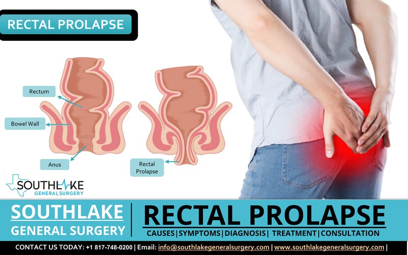Rectal Prolapse - Diagnosis, Symptoms, and Treatment