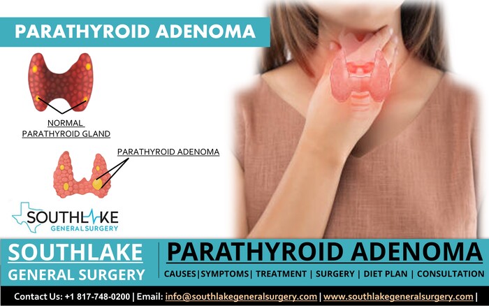 Parathyroid Adenoma