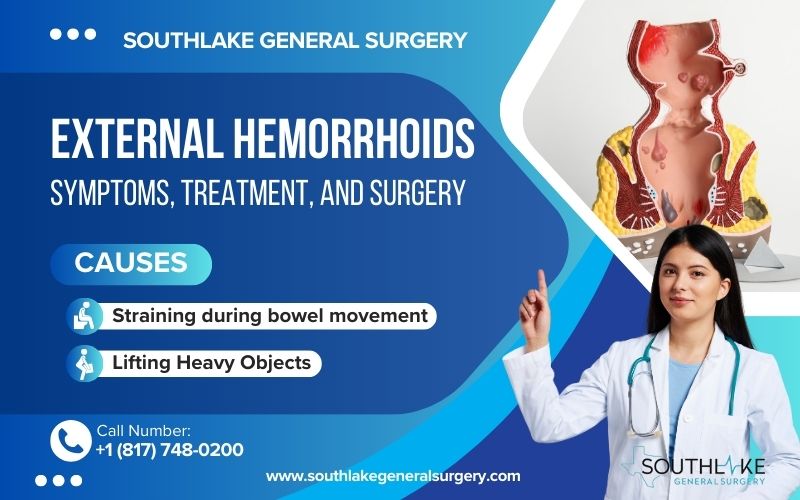 Image of the External hemorrhoids.