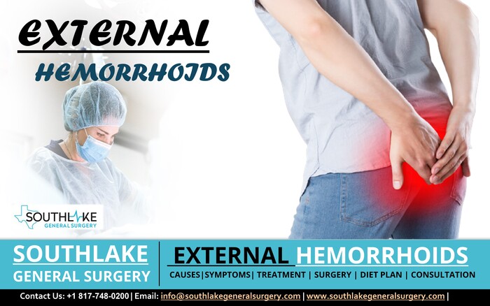 External Hemorrhoids – Symptoms, Treatment, and Surgery