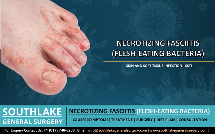 Necrotizing Fasciitis (Flesh-Eating Bacteria) – SSTI