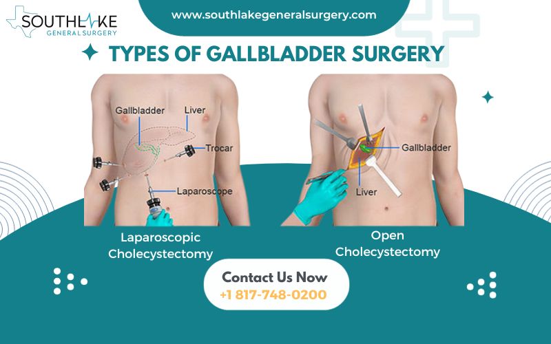 Two side-by-side images depicting a laparoscopic cholecystectomy procedure and an open cholecystectomy procedure.
