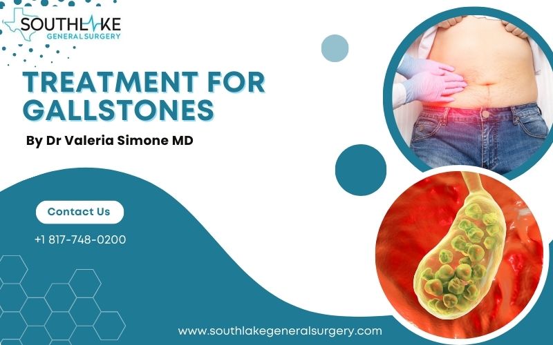 Treatment for Gallstones