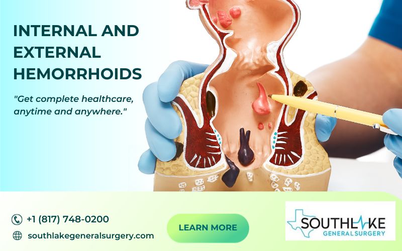 Image of internal and external hemorrhoids, swollen blood vessels around the anus.