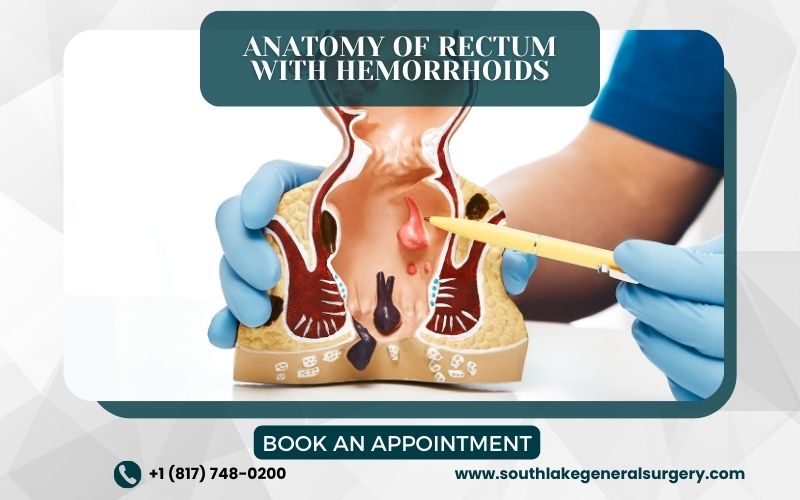 An image illustrating the anatomy of the rectum and anus, highlighting the swollen blood vessels known as hemorrhoids, and providing a visual aid for understanding hemorrhoids what is.