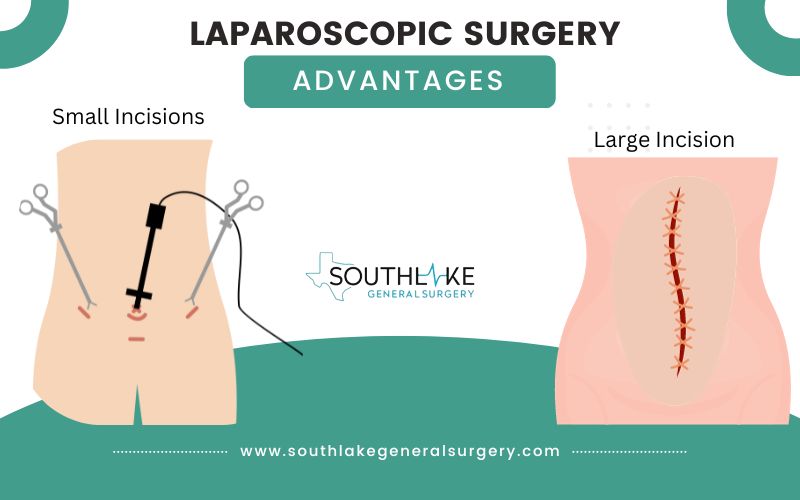 Advantages of Laparoscopic Surgery: Smaller incisions and reduced scarring compared to open surgery.