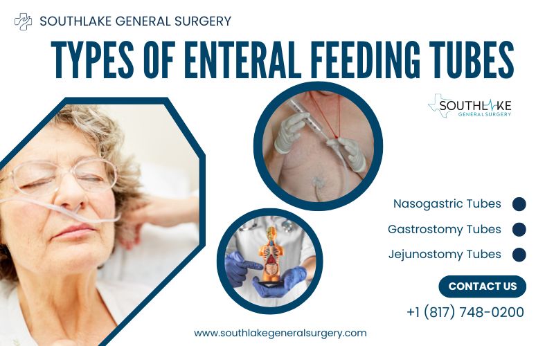 Visual comparison of various enteral feeding tube types under Surgical nutrition, including nasogastric, gastrostomy, jejunostomy, and nasoenteric tubes.