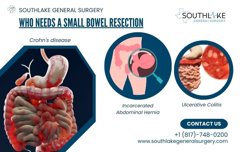 Collage illustrating various medical conditions necessitating small bowel resection, such as Crohn's disease, tumors, and trauma.