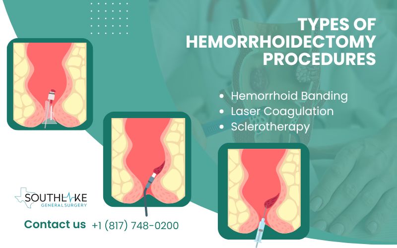 Diagram comparing traditional hemorrhoidectomy with advanced surgical techniques like hemorrhoid banding, laser coagulation, and sclerotherapy, illustrating different treatment options.