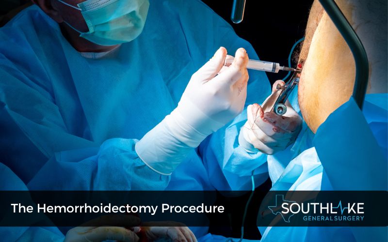 Surgical illustration demonstrating the step-by-step process of a hemorrhoidectomy, from anesthesia administration to excising hemorrhoidal tissue, with captions explaining each stage.