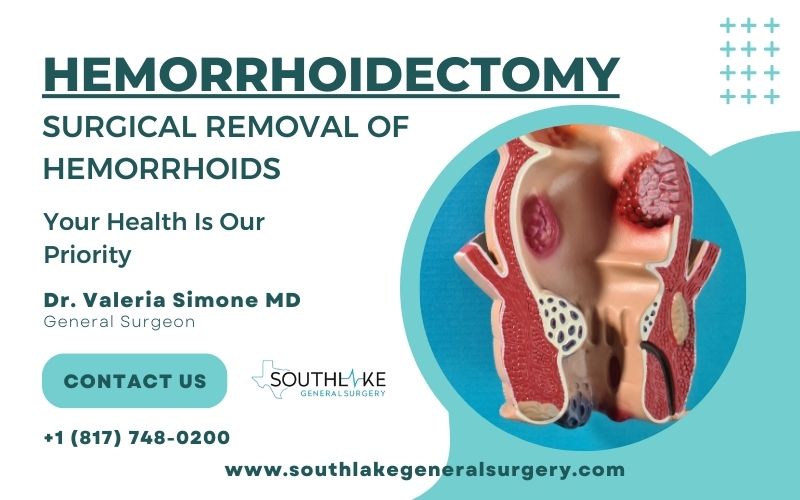 Hemorrhoidectomy - Surgical Removal of Hemorrhoids