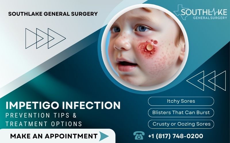 Impetigo Infection Prevention Tips & Treatment Options