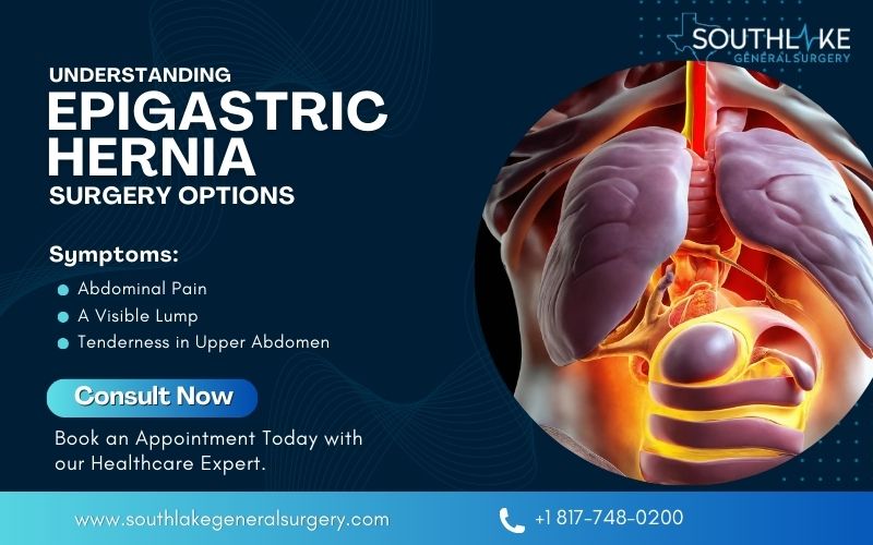 Understanding Epigastric Hernia Surgery Options