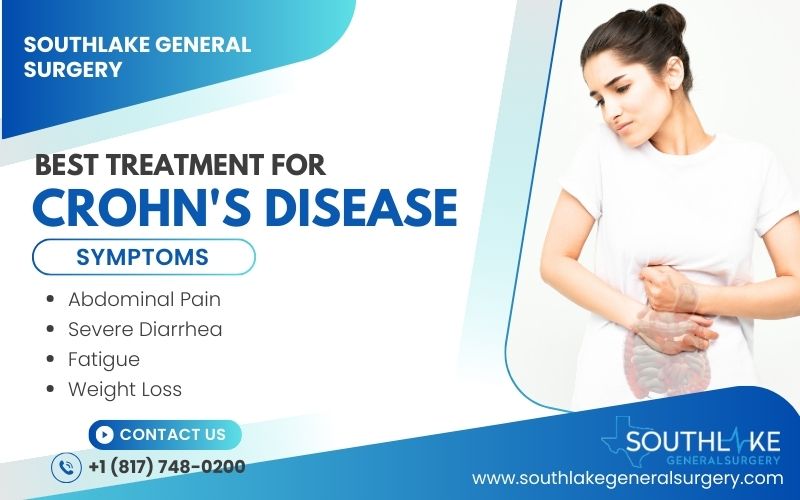 Best Treatment for Crohn's Disease Expert Insights