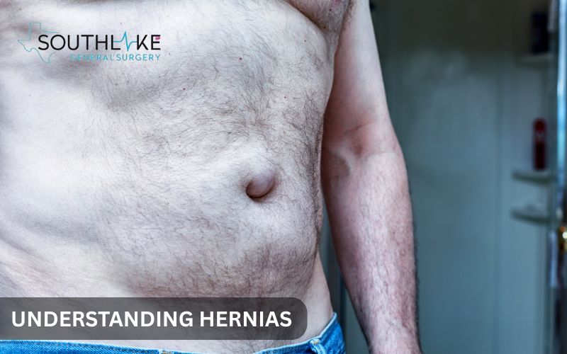 Illustration of hernia formation where intestine pushes through a weak spot in abdominal muscle wall.