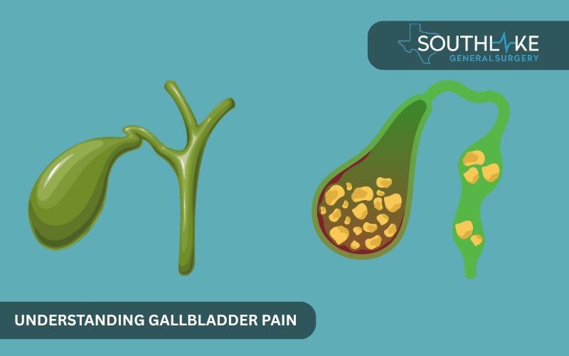 Side-by-side image comparing a healthy gallbladder with one blocked by gallstones in the bile duct.