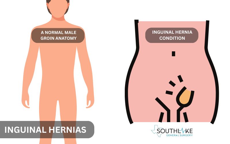 Comparison of normal groin anatomy and an inguinal hernia, showing tissue protrusion in the inguinal canal.