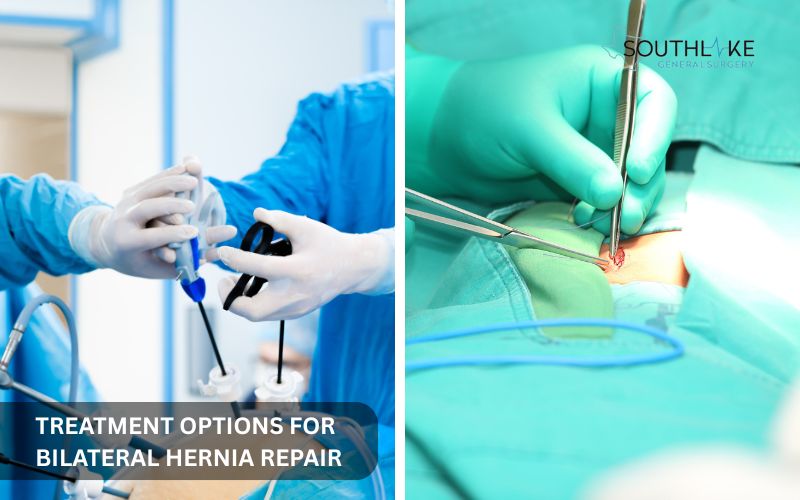 Comparison of laparoscopic and open surgery for bilateral inguinal hernia repair.