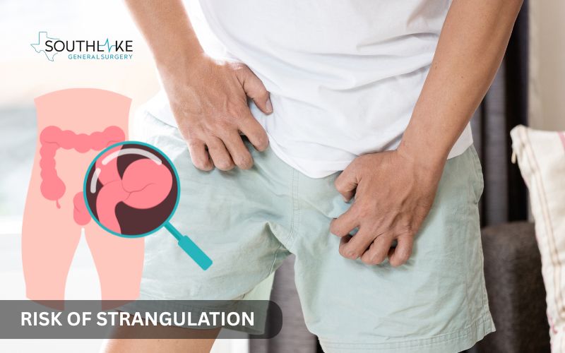 Infographic showing progression of an untreated hernia leading to complications like incarceration and strangulation.