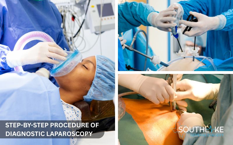 Step-by-step illustration of the diagnostic laparoscopy procedure from incision to closure.