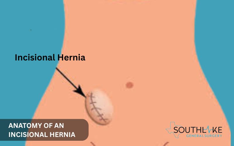 Illustration of an incisional hernia on the abdominal wall showing tissue bulge through previous surgical incision site.