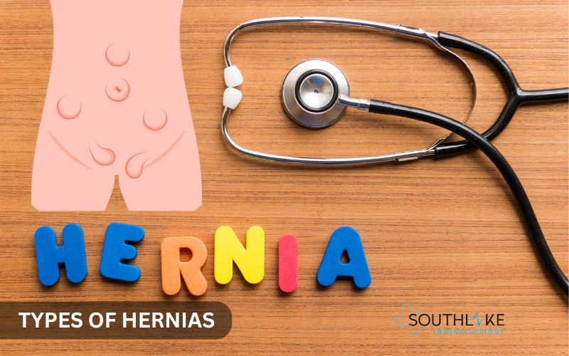 Labeled diagram showing common types of hernias by location including inguinal, incisional, and umbilical.