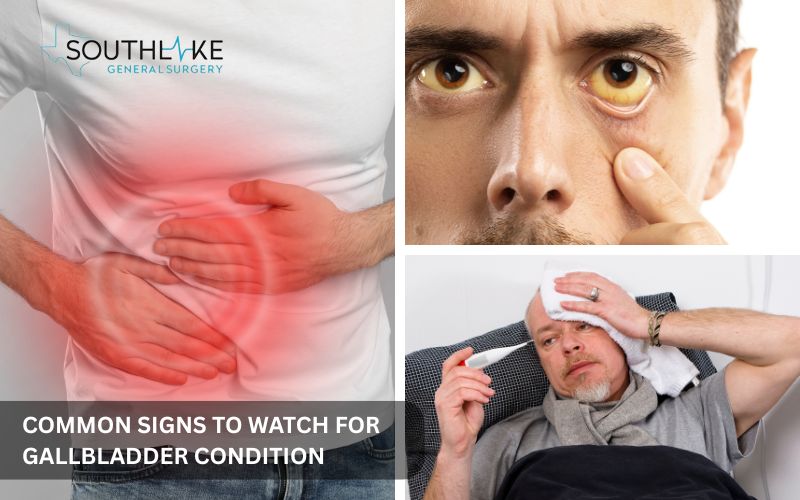 Visual showing common symptoms of gallbladder disease, including abdominal pain and jaundice.