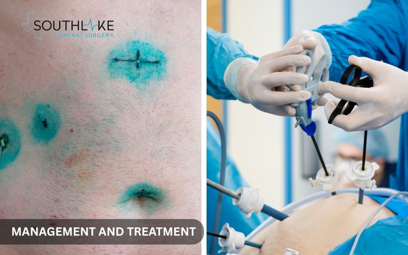 Laparoscopic gallbladder removal procedure using small incisions and a camera for minimally invasive surgery.