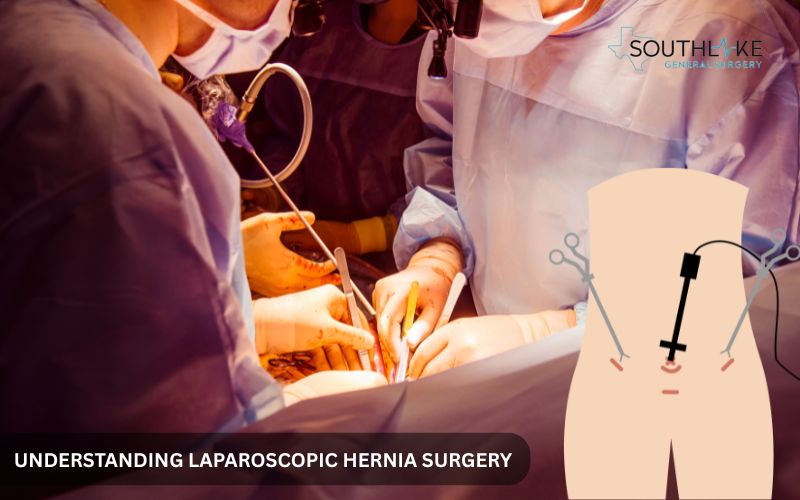 Medical diagram showing laparoscopic hernia repair with small incisions and surgical mesh placement.