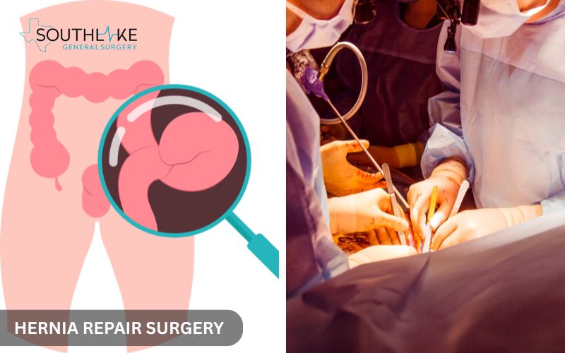 Surgical mesh being placed in abdominal wall during laparoscopic hernia repair.