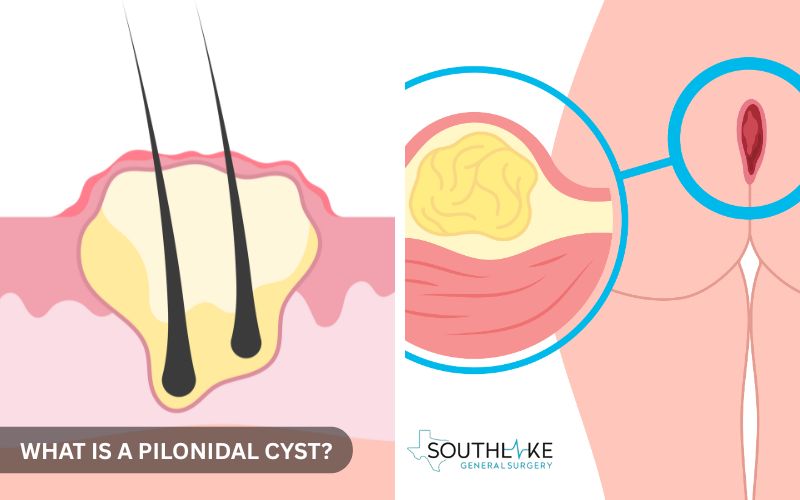 Close-up medical illustration of an infected pilonidal cyst with pus and swelling.